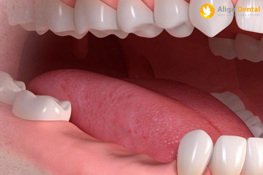 Mất Nhiều Răng Phải Làm Sao? Giải Pháp Phục Hồi Răng Tốt Nhất