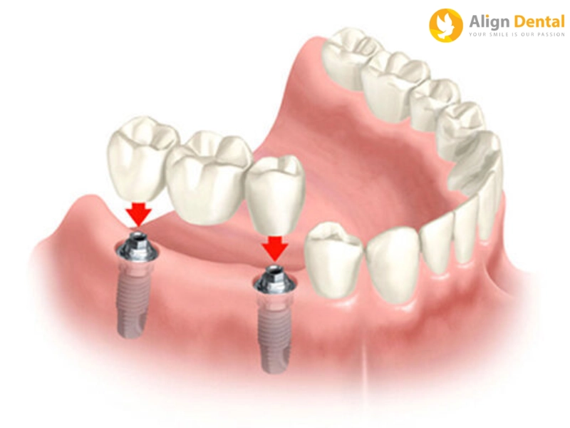 Trồng răng Implant sẽ giúp bạn phục hồi chức năng của răng