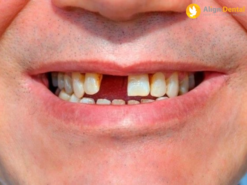 Ảnh hưởng mất răng cửa đến sức khỏe răng miệng