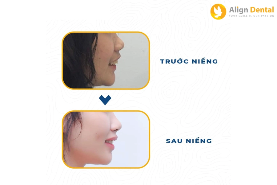 [Giải Đáp] Niềng Răng Có Thay Đổi Xương Hàm Không?