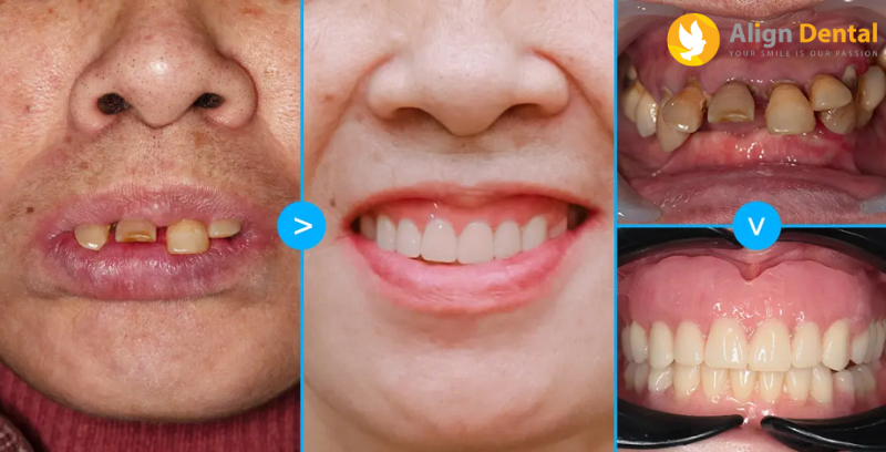 Bệnh nhân Nguyễn Thị Mai qua quá trình trồng răng Implant tại Nha khoa Align Dental