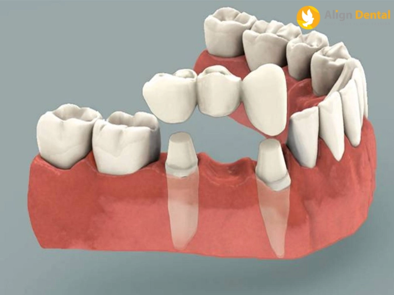Trồng răng giả thường không ảnh hưởng đến sức khoẻ