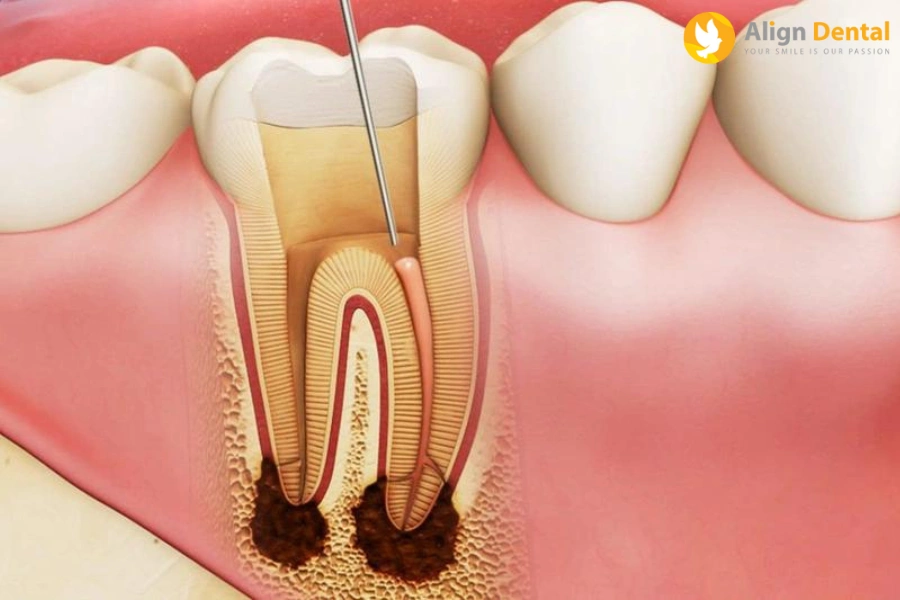 Răng Đã Lấy Tủy Có Niềng Được Không? Cần Lưu Ý Những Gì