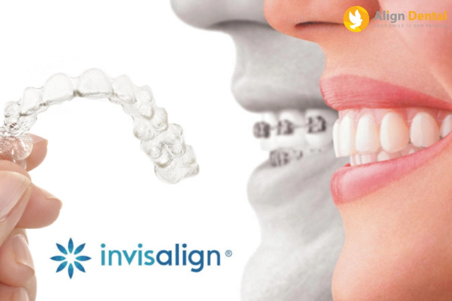 Tìm Hiểu Những Ưu Điểm Của Niềng Răng Invisalign Đem Lại 