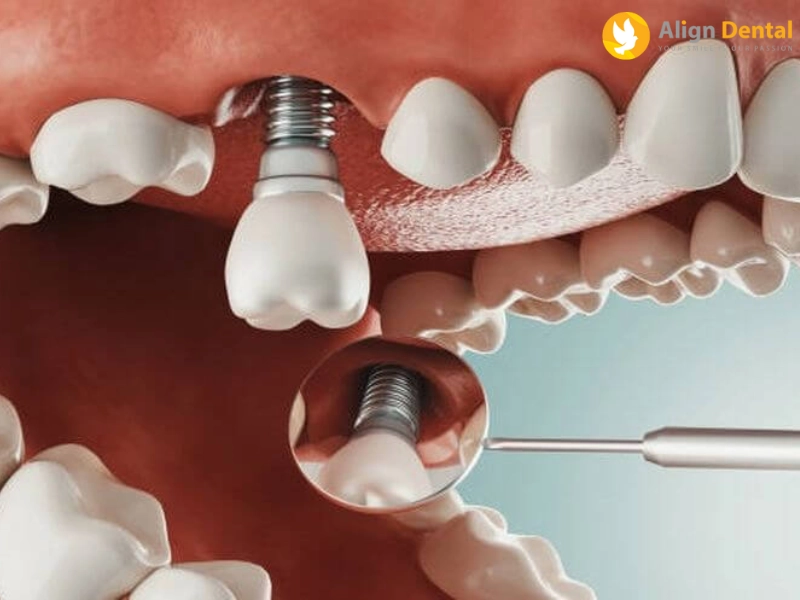Align Dental - Địa chỉ trồng răng Implant uy tín, an toàn tại Hà Nội