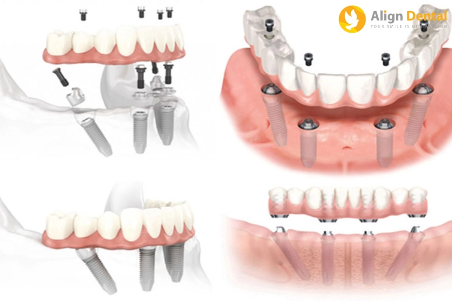 Hàm Tháo Lắp Trên Implant Là Gì? Khi Nào Nên Sử Dụng?