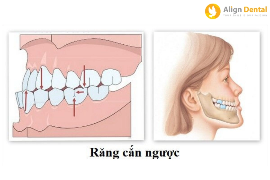 Khớp Cắn Ngược Là Gì? Nguyên Nhân Và Cách Điều Trị Ra Sao?