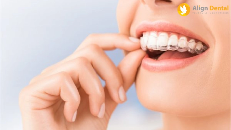 quy trình niềng răng invisalign
