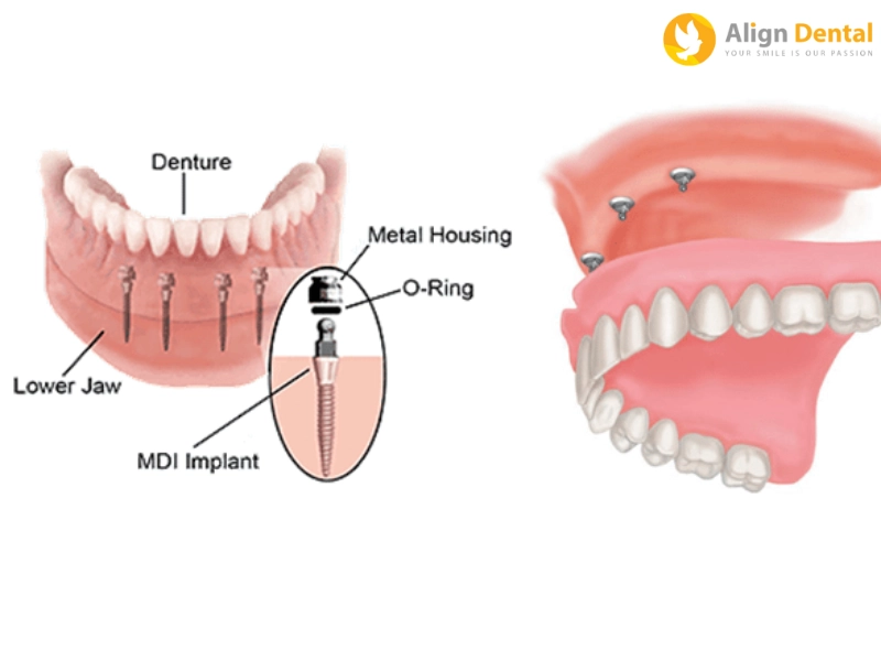 Trồng răng mini Implant giá bao nhiêu?