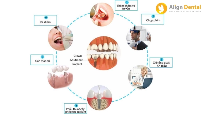 trồng răng implant toàn hàm giá bao nhiêu