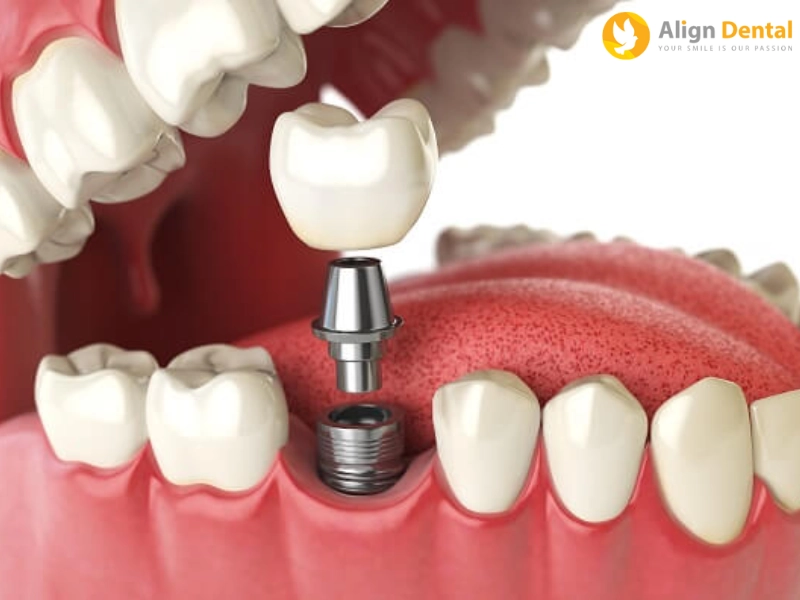 Các bác sĩ khuyến khích trồng răng số 6 bằng phương pháp Implant