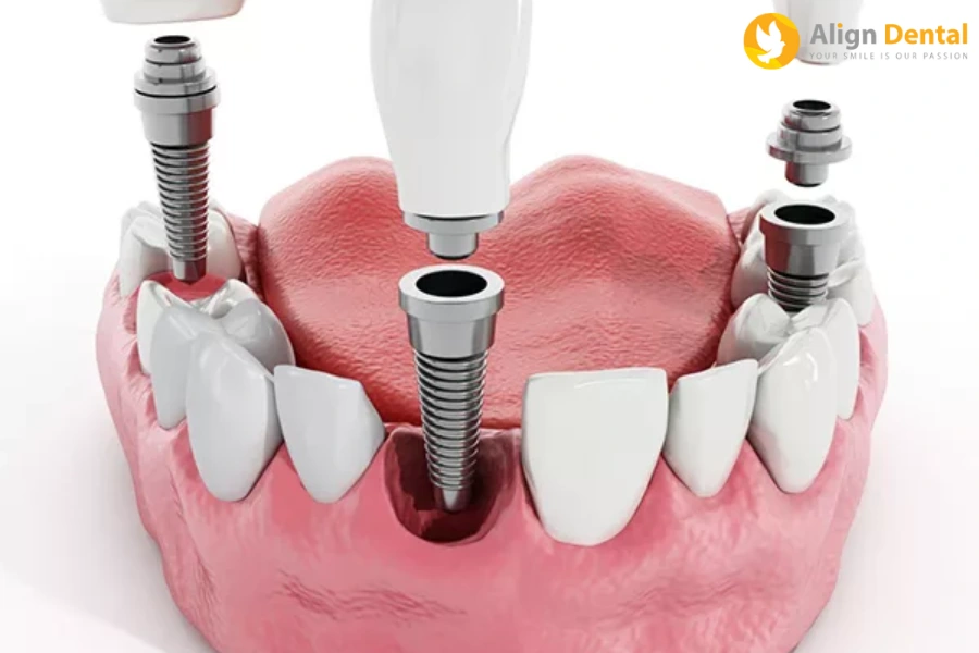 [Giải Đáp] Trồng Răng Implant Bao Nhiêu Tiền 1 Cái?