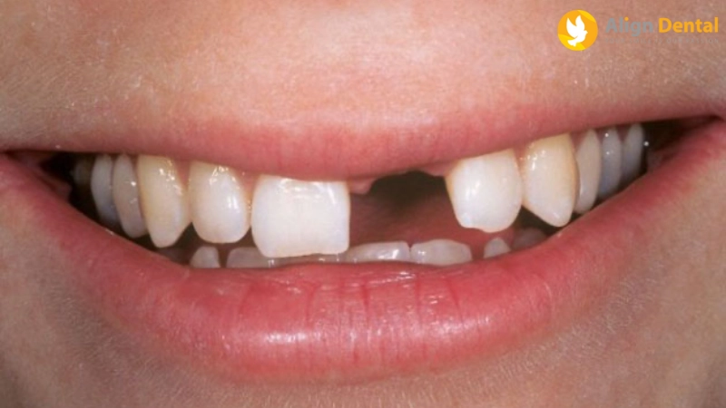 sau khi nhổ răng bao lâu thì trồng implant