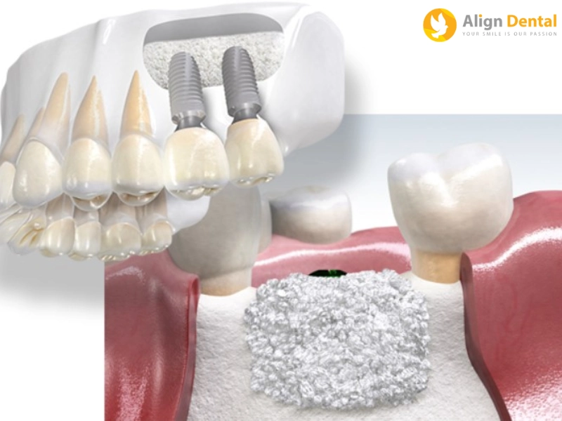 chăm sóc răng sau khi cắm implant