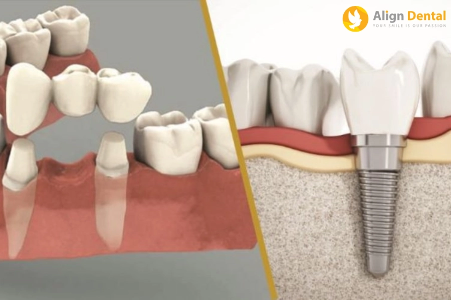 Nên Làm Cầu Răng Hay Cấy Ghép Implant Chia Sẻ Từ Chuyên Gia