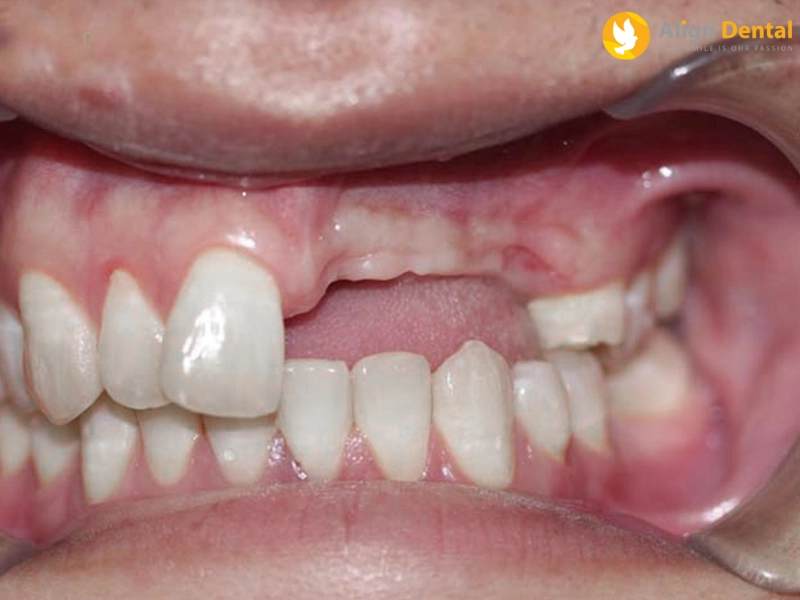 Nguyên nhân gây ra tình trạng mất răng cửa