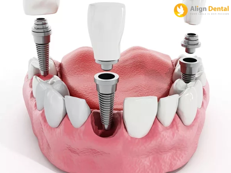 trồng răng implant bao nhiêu 1 cái