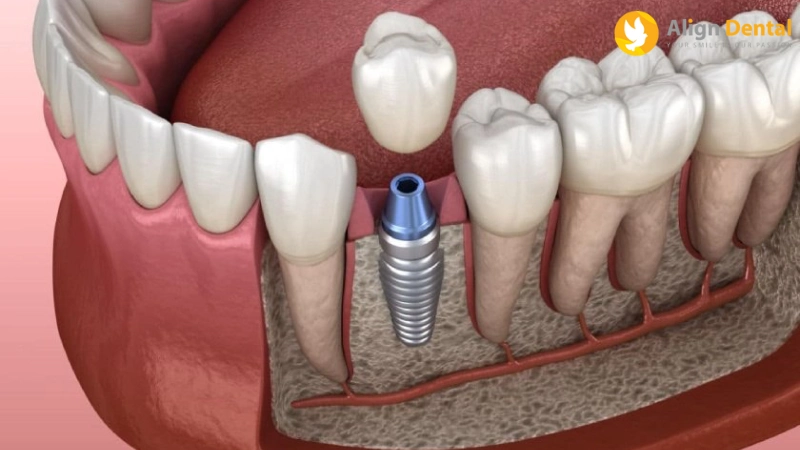 có nên trồng răng implant