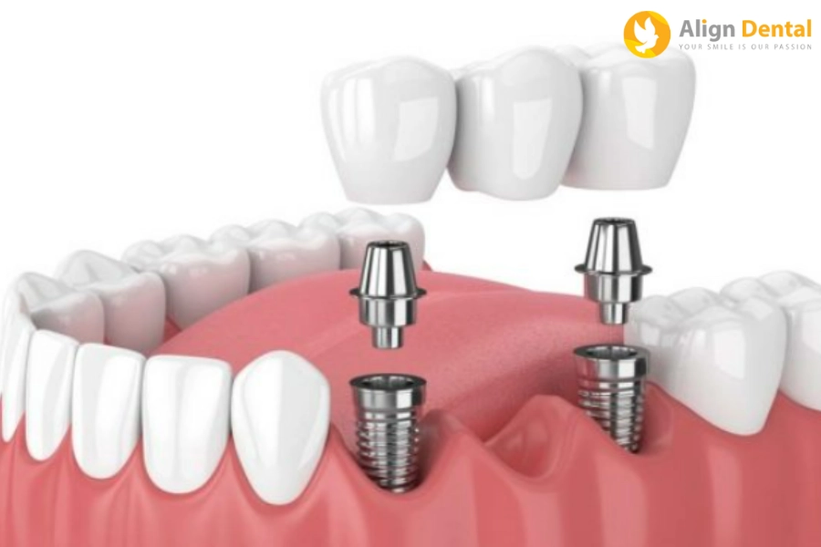 Cấy Implant Bao Lâu Thì Gắn Răng? Những Lưu Ý Khi Cấy Implant