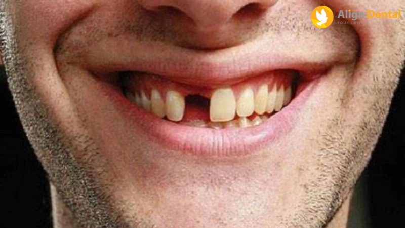 có nên trồng răng implant