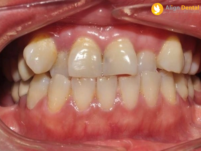 răng lòi xỉ là gì