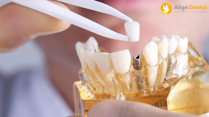 phục hình răng sứ trên implant