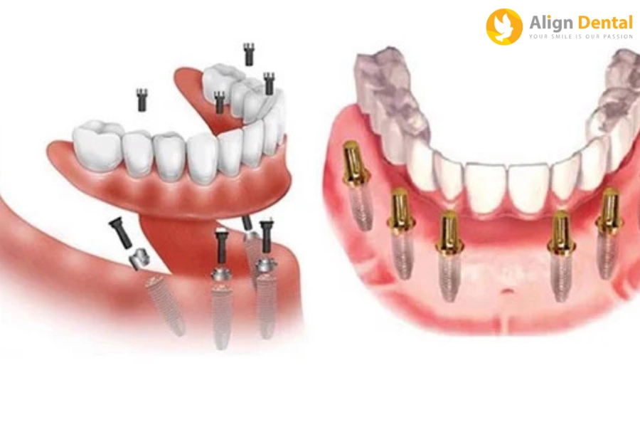 Trồng Răng Implant Toàn Hàm Giá Bao Nhiêu? Yếu Tố Quyết Định Giá Là Gì?