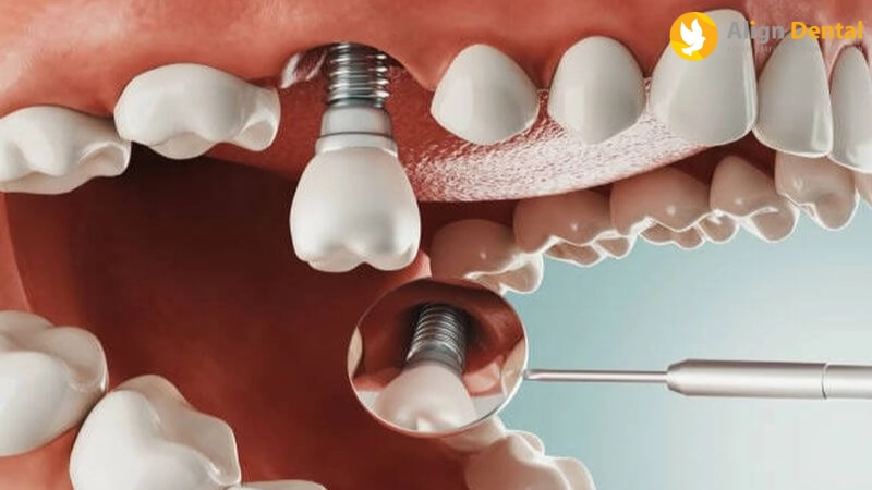 tuổi thọ răng implant