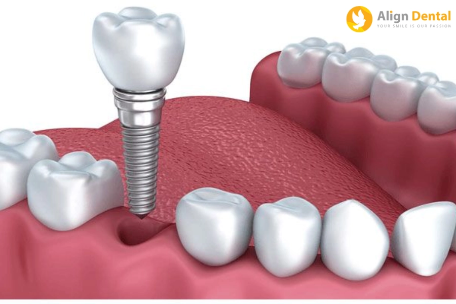 Thời Gian Trồng Răng Implant Có Lâu Không? Quy Trình Bao Gồm Mấy Bước?