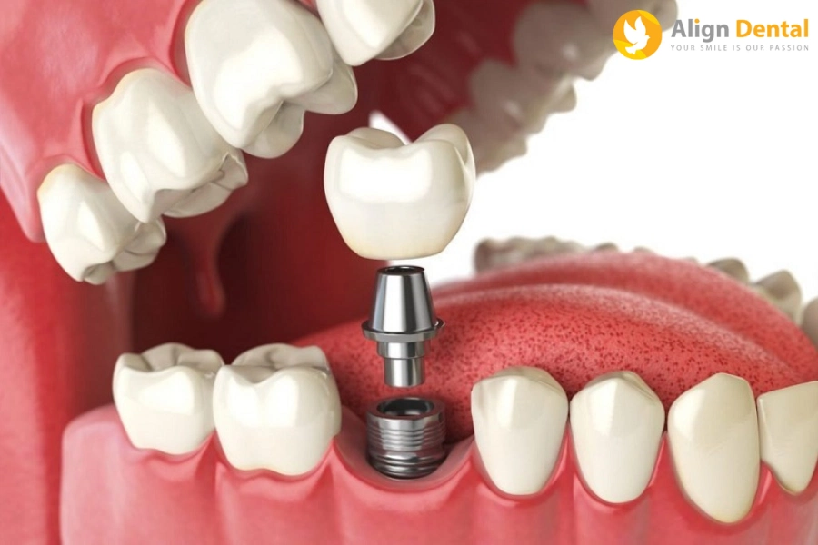 Có Nên Trồng Răng Implant? Trường Hợp Nào Nên Trồng Implant?