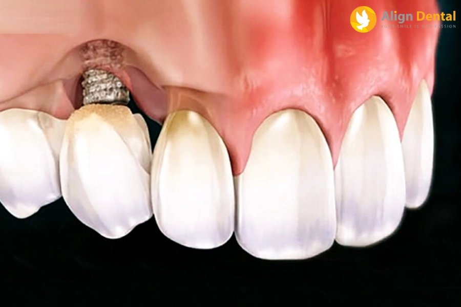 Biến Chứng Và Tác Hại Của Việc Trồng Răng Implant Là Gì?