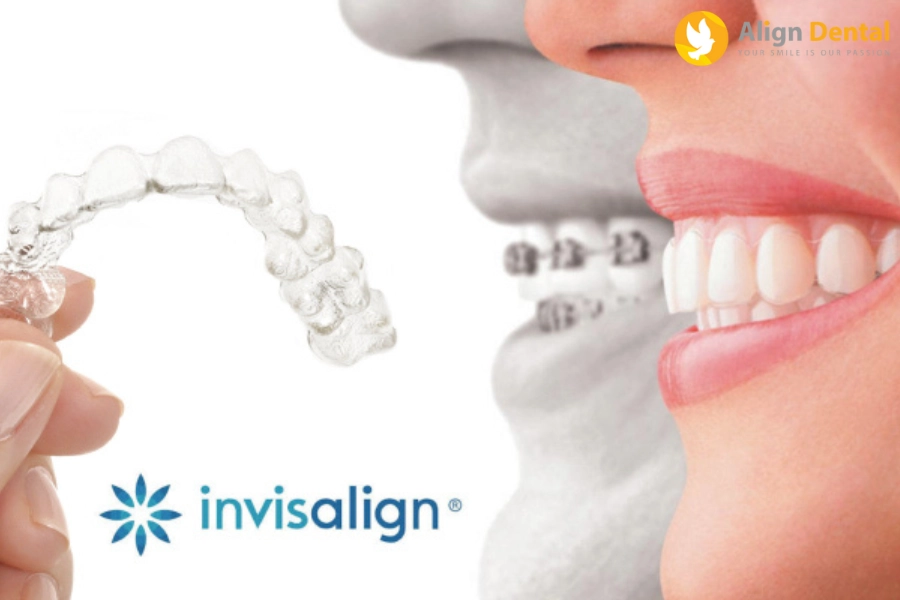 Niềng Răng Invisalign Có Hiệu Quả Không? Cùng Tìm Hiểu Ngay!