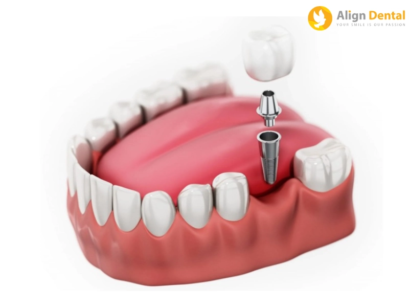 Phương pháp cấy ghép implant là lựa chọn hiện đại và tiên tiến nhất để trồng răng hàm bị sâu