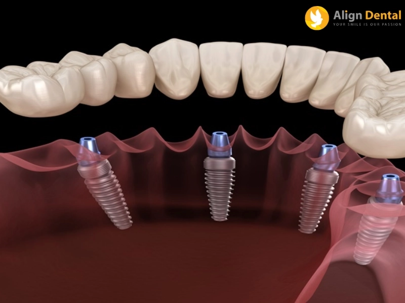 Địa chỉ trồng răng uy tín, giá tốt tại Nha khoa Align Dental