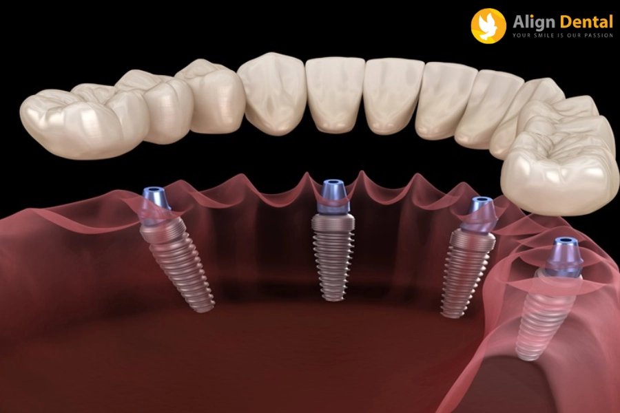 [Hỏi - Đáp] Trồng Răng Implant All On 4 Giá Bao Nhiêu?