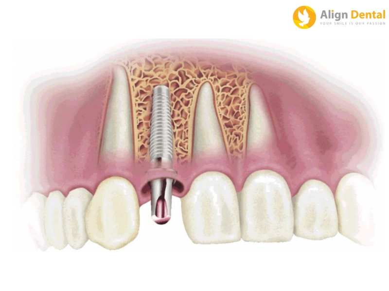 Những thói quen xấu dẫn đến răng implant bị viêm