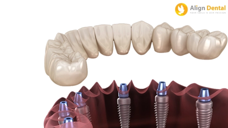 Những yếu tố lựa chọn phương pháp trồng 3 răng liên tiếp hiệu quả