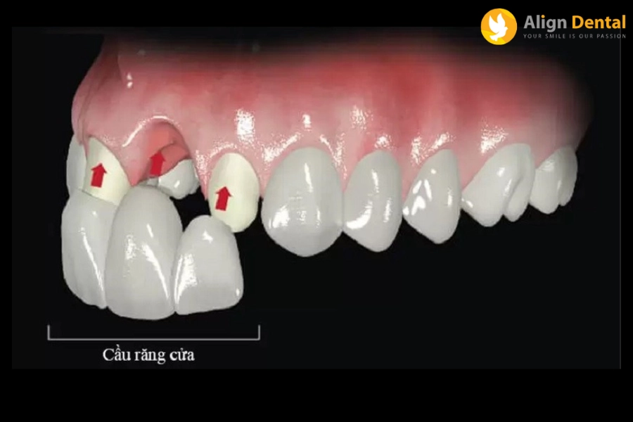 Làm Cầu Răng Sứ Có Tốt Không? Có Nên Thay Cầu Răng Sứ Bằng Răng Implant?