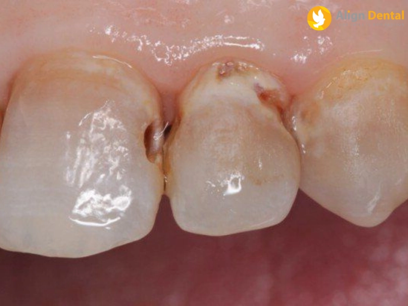 Sâu răng khi niềng răng