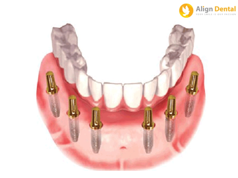 Quy trình cấy ghép Implant All on 6 tại Align Dental