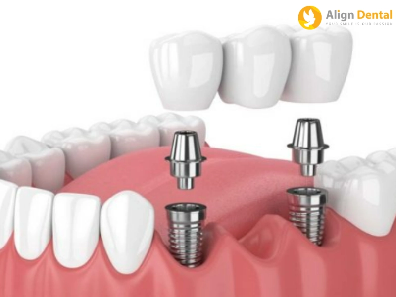 cấy implant bao lâu thì gắn răng sẽ phụ thuộc nhiều yếu tố