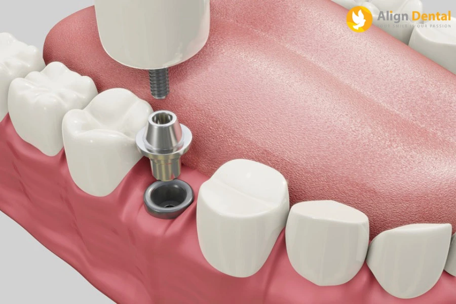 Các Bước Cắm Và Trồng Implant Chuẩn Y Khoa Tại Align Dental