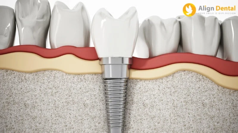 trồng răng implant toàn hàm giá bao nhiêu