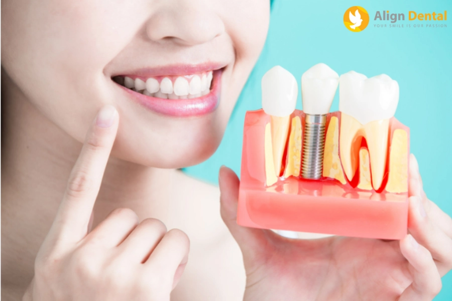 Cấy Ghép Implant Mất Thời Gian Bao Lâu? Yếu Tố Ảnh Hưởng Thời Gian Là Gì?