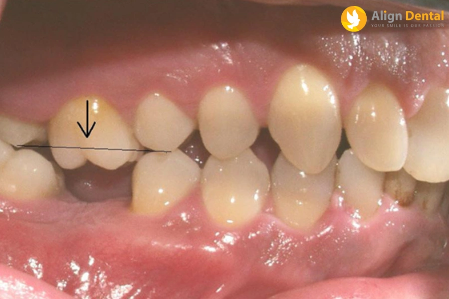 Kéo Răng Số 7 Thay Răng Số 6, Số 8 Thay Số 7 Có Được Không?