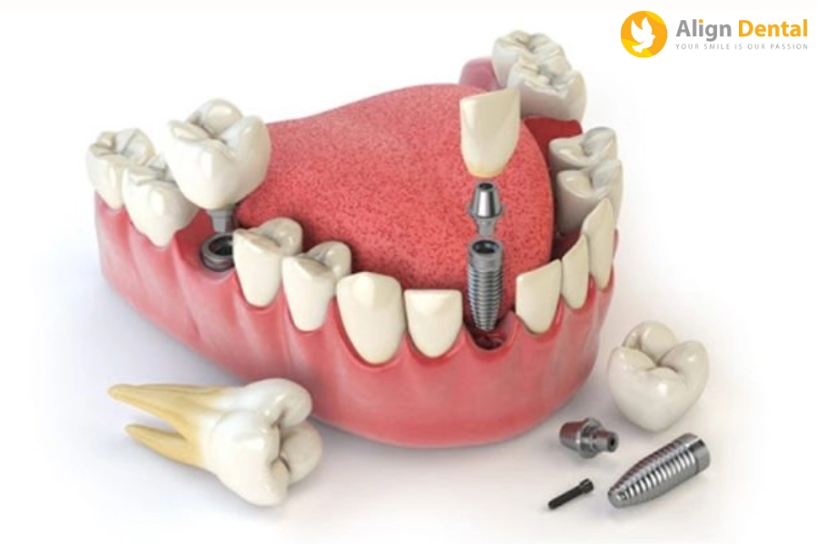 #Phương Pháp Cấy Ghép Mini Implant Là Gì? Giá Bao Nhiêu?