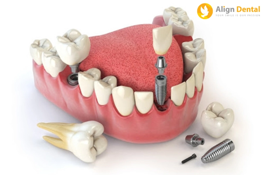 Trồng Răng Implant Có Đau Không? Cách Giảm Đau Là Gì?