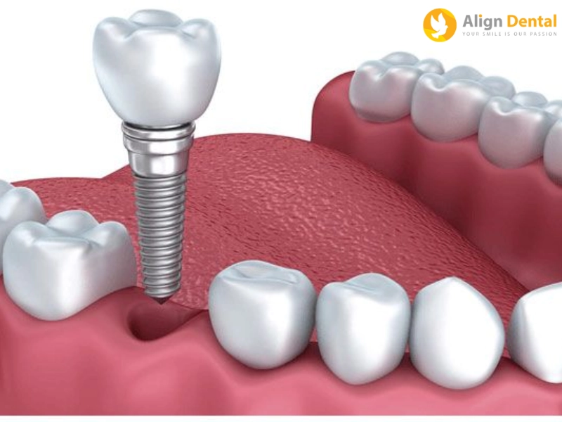 trồng răng implant thường có thể ăn được sau khoảng 5 giờ