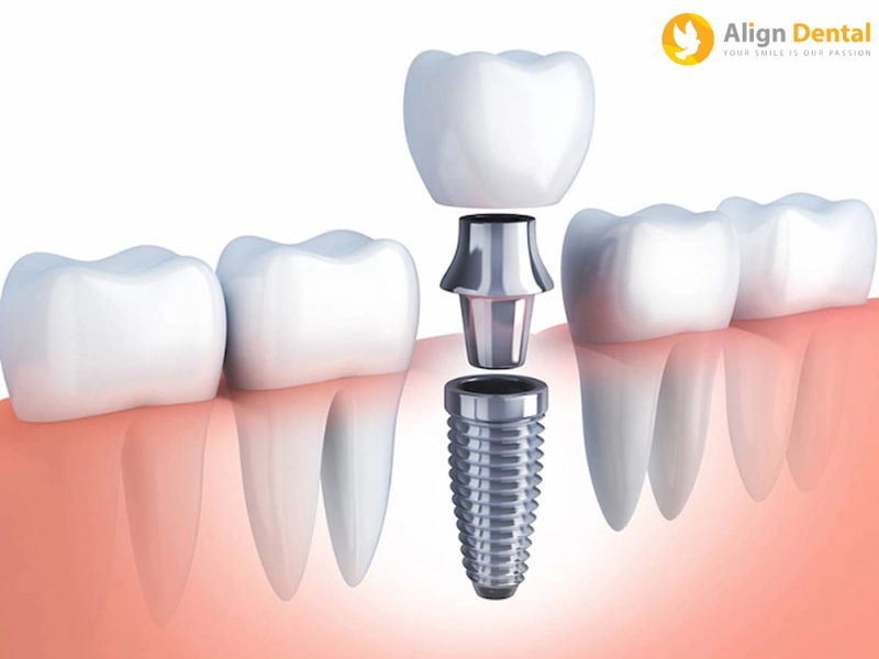 trồng răng implant là giải pháp tối ưu trong trường hợp mất răng