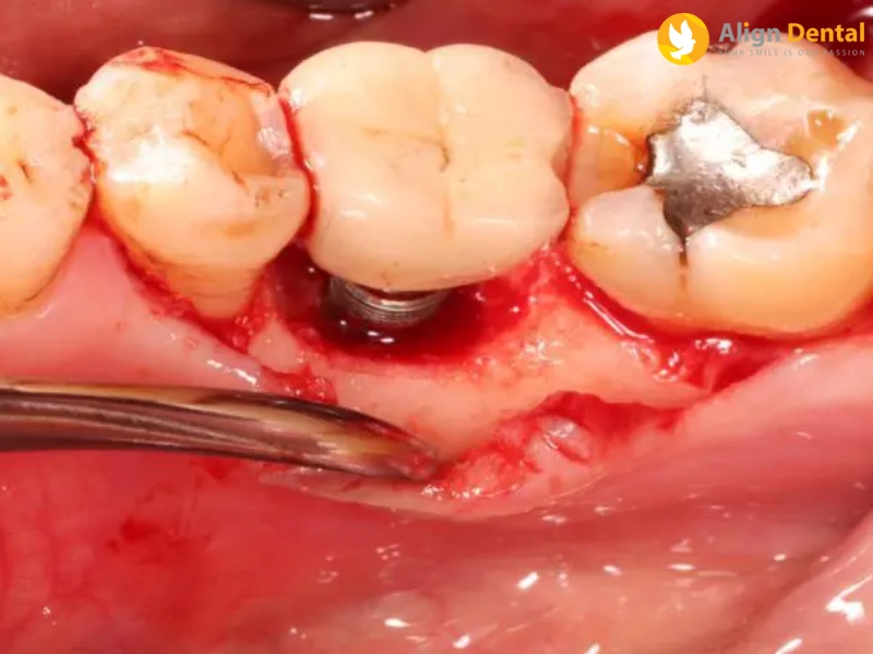 Dấu hiệu của răng implant bị viêm